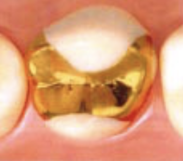 ゴールドインレー