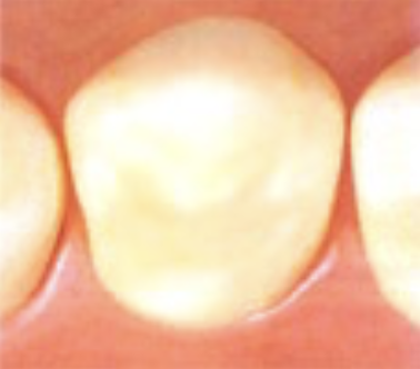 ジルコニアインレー