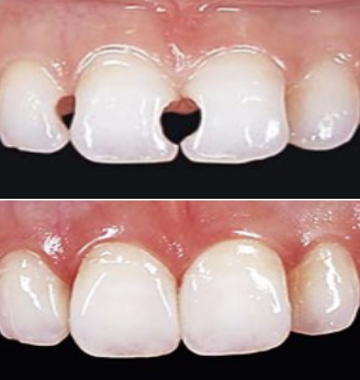 ダイレクトボンディング