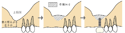 ソケットリフト