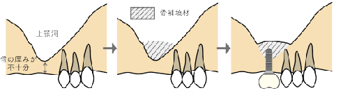 サイナスリフト