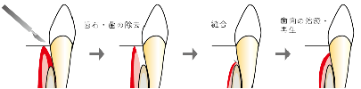 保険適応外歯周外科